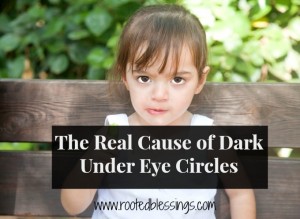 Dark Under eye circles